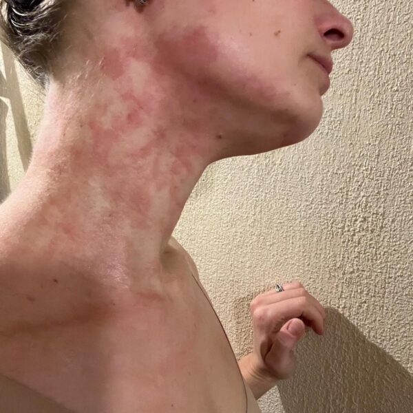 Amanda Husum der har fået udslet på kroppen af stress